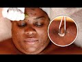 EXTREME Facial to Get Rid of Acne and Hyperpigmentation