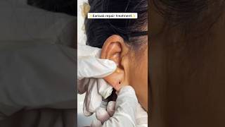 👂How to Repair a Torn Earlobe Safely✨#viralyoutubeshorts#shortsviral #trending