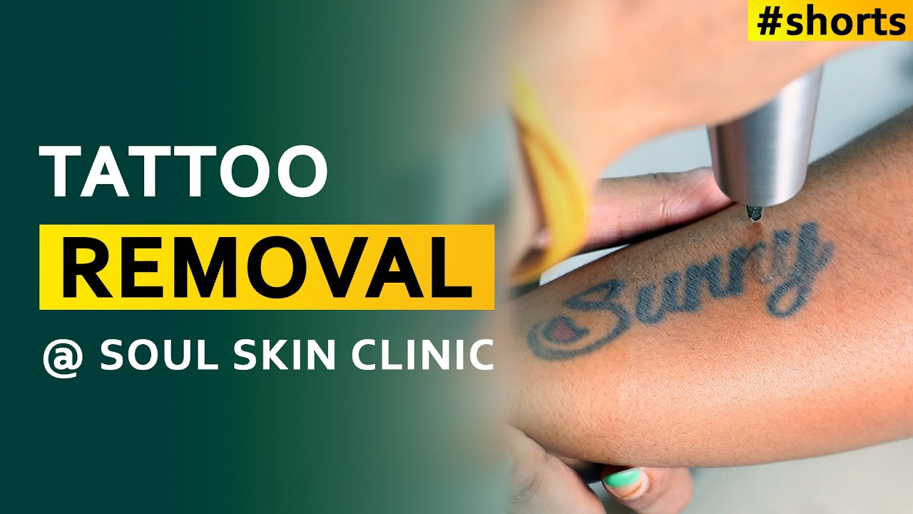 Laser tattoo removal - Novosilska clinic