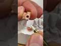 Minimum width Mini-SYTON bridge with overlap & exceptional hygiene for Dr. Leslee Timm in Wisconsin