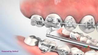Orthodontic Treatment for Overjet (Overbite) - Esprit Appliance