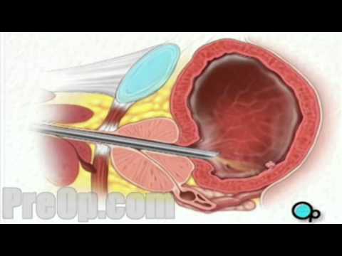 Cystoscopy Male via Penis PreOp® Patient Education Medica Video
