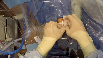 Ultrasound-Guided Radial Arterial Line Insertion