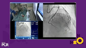 A mindset shift in the cathlab: leveraging technologies for PCI in complex patients - EuroPCR 2025