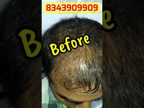 PRP Hair LossTreatment Before And After | #ytshorts #shorts