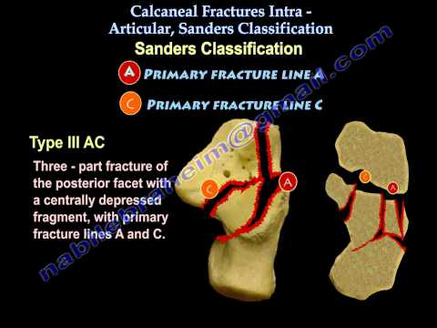 Ankle Fractures. There are many of important topics…, by Nabil Ebraheim, Thrive Global