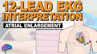 IDENTIFY Atrial Enlargement on 12Lead EKG