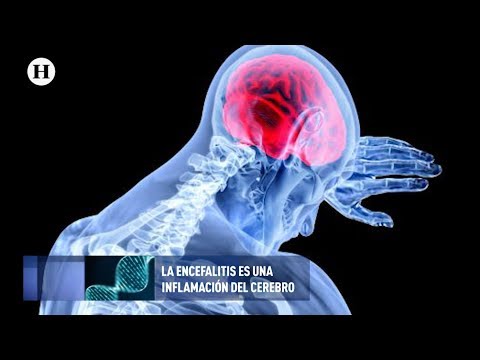 Video: ¿Cómo tratar la encefalitis?