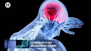 ¿Qué es y cómo se trata la encefalitis?