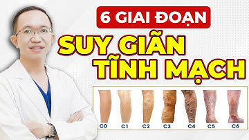 6 Giai Đoạn Suy Giãn Tĩnh Mạch Mọi Người Cần Phải Biết | Bác Sĩ Trần Minh