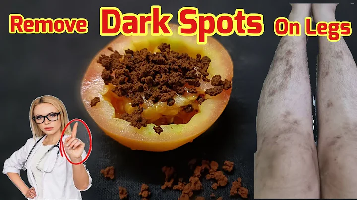 Only 2 days!! How To Remove DarkSpots On Legs, Mosquito Bites, Scar, Hyperpigmentation On Legs Fast