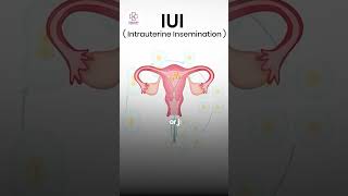 What is IUI and how can it help couples struggling to conceive?