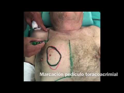 Vídeo: Configuraciones Quirúrgicas Del Colgajo Pectoral Mayor Para La Reconstrucción De Defectos Esternoclaviculares: Una Revisión Sistemática Y Una Nueva Clasificación De Las Técnicas De