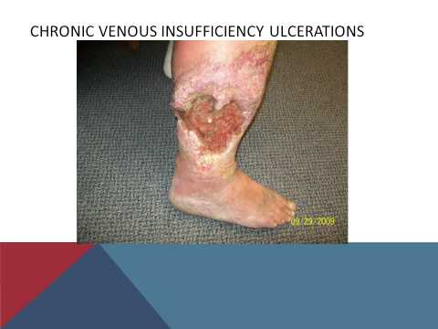 Video: Lymphostasis Of The Lower Extremities - Treatment, Causes
