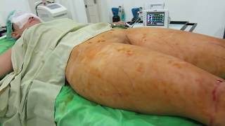 Plastic Surgery #20 A simple Case of Liposuction for girl