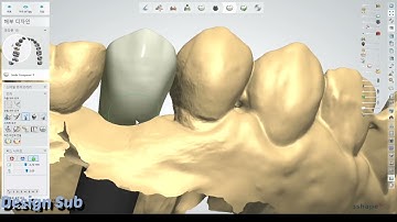 3shape design (simple case abutment&crown osstem)😀