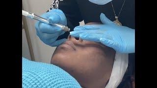 Diamond Tip Microdermabrasion w Exfoliating Peel Luxury Spa Wellness Center