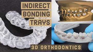 Indirect Bonding Trays - 3D ORTHODONTICS