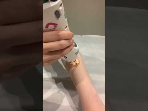 هل ينمو الشعر مجددا بعد عمل ليزر إزالة الشعر