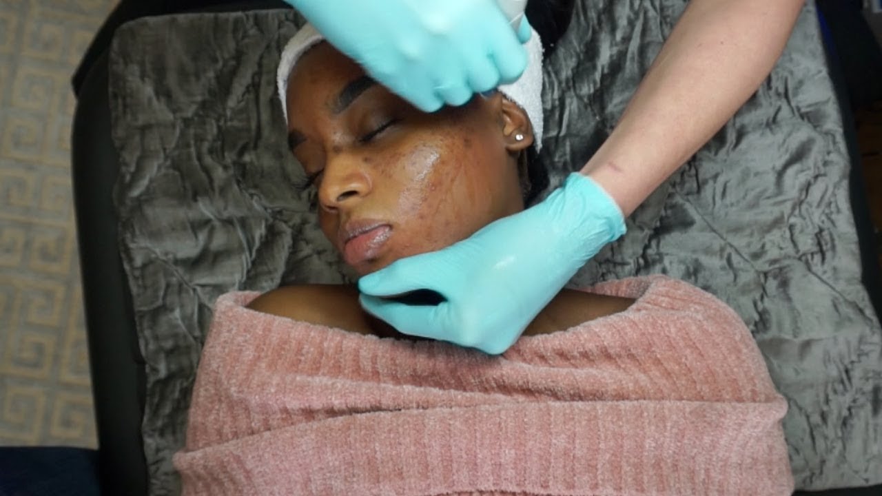 GET RID OF WHITEHEADS | Acne Hydrafacial Vlog