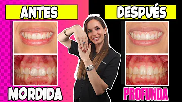 ¿Los brackets arreglan la sobremordida?