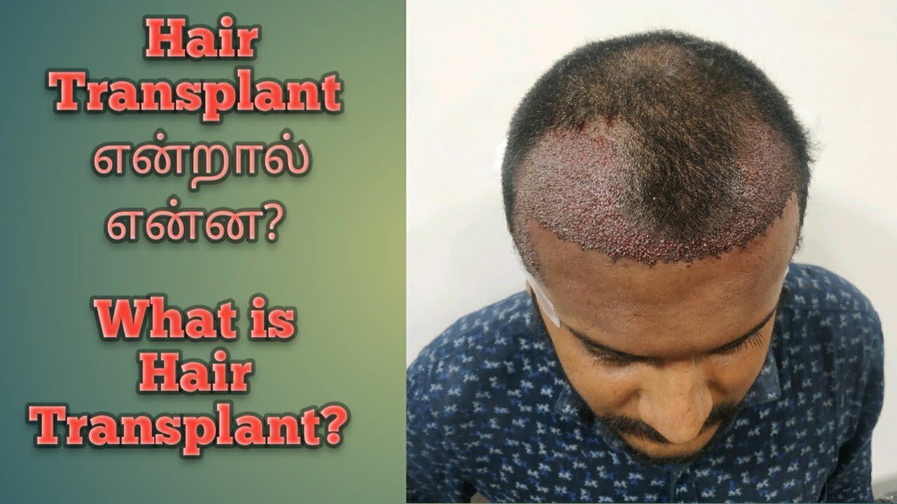 What is hair transplant in Tamil / Experience of hair transplant in