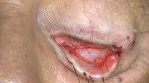 Transconjunctival retractor reinsertion w lateral tarsal strip 4 treatment of involutional ectropion