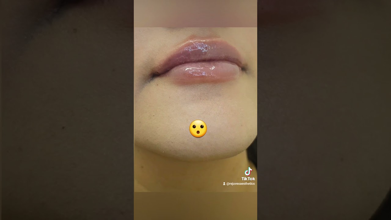 What does 1ml of lip filler look like? YouTube