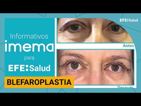 IMEMA Newsletter: "Blepharoplasty to rejuvenate your look"