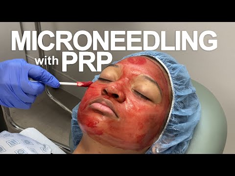 microneedling-with-prp---norah-gourlay,-np-c-|-west-end-plastic-surgery