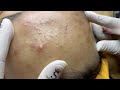 Forehead Acne And  Pimples | Mụn Trán - SacDepSpa#322