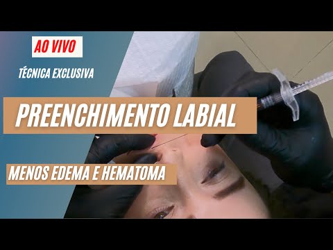 preenchimento labial - AO VIVO