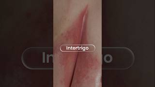 Intertrigo (Skin Fold Rash): Causes, Symptoms & Best Treatment | Dr. Neeharika Goyal