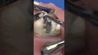 Peri-implantitis Course by Dr. Alberto Monje | 2024  #dentistry #doctor