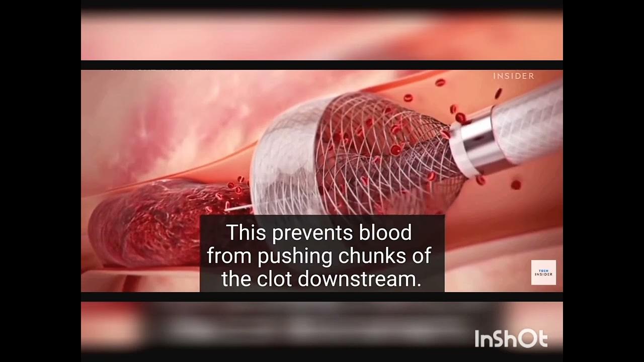 HOW THIS DEVICE REMOVE BLOOD CLOT SAFELY YouTube