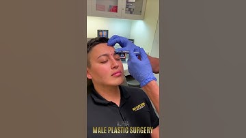 NewTox Treatment | Jeuveau By Evolus | Dr. Douglas Streinbrech