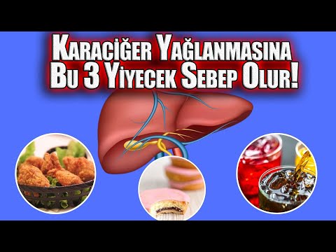 Karaciğer Yağlanmasına Bu 3 Yiyecek Sebep Olur ! Sonu Ölümcüldür Uzak Durun!