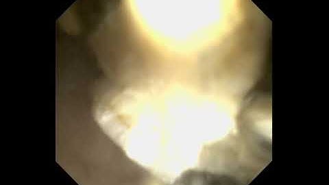 Cholangioskopie mit Walz EHL Steinzertrümmerung