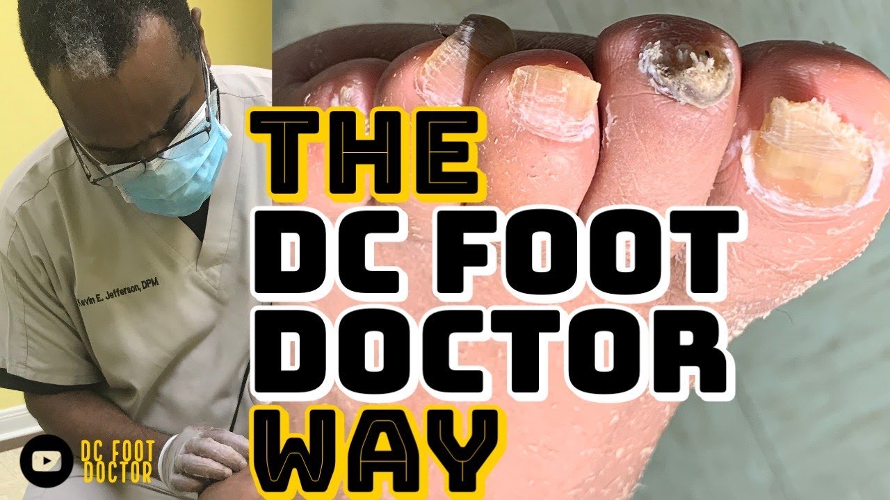 The DC Foot Doctor Way Toenail Dystrophy and Fungal Infection YouTube