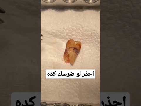 خلع ضرس ببساطة