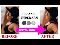 Underarms Darkness Removal | How to Get Rid of Underarm Darkness and Bumps [FAST]