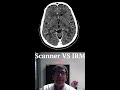 Shorts  scanner vs irm pour des mtastases crbrales