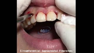 circumferential supracrestal fibrotomy