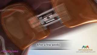 Orthodontic Expander or Spacer - Haas Appliance
