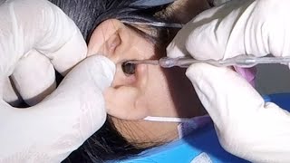 Woman&#39;s Earwax PLUG Removal Using Ear Curette