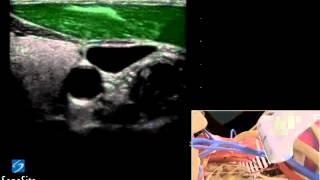 3D Cómo Hacer Inserción Ecoguiada De Catéter En Yugular Interna Largo - Ultrasonido Sonosite