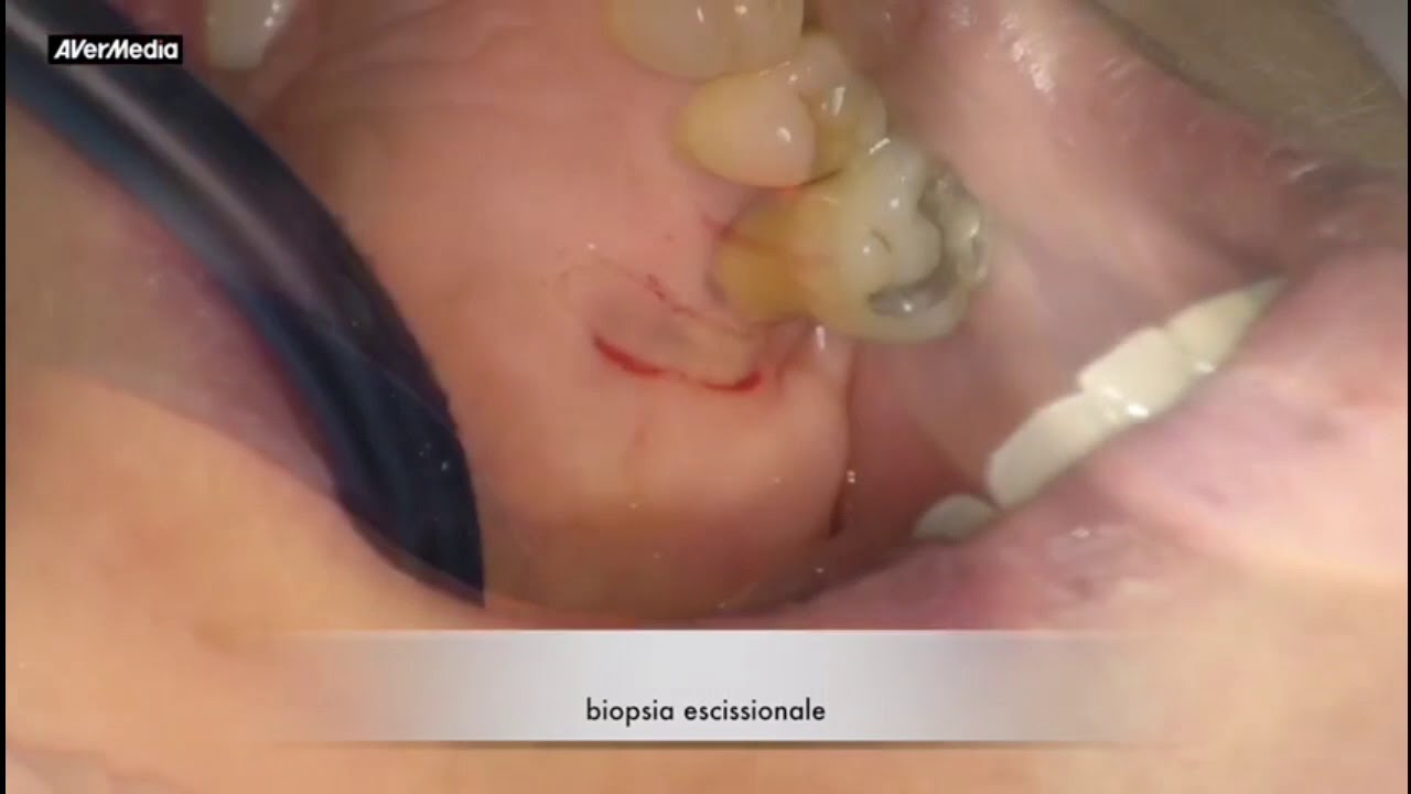 macula melanotica Macula melanotica labial