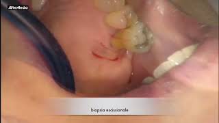 macula melanotica Mcula labial #LesionesPigmentadasDeLaMucosaBucal Labial melanotic macule. B). Increased