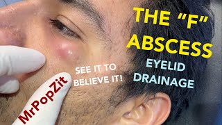 The abscess drainage spells the letter “F”, you gotta see it to believe it! Eyelid abscess drained. 