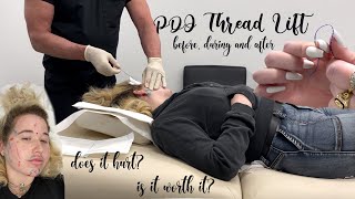 PDO Thread Lift - worth it?